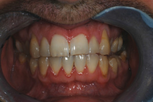 Figure 1 – the upper right central incisor shows early erosive tooth wear. The buccal/facial surface has lost definition of the surface enamel and the incisal edge has early wear. The upper left central incisor shows slightly more wear having wear along the incisal edge and less surface definition.