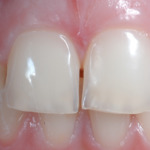 Figure 2 - Early erosive tooth wear on central incisors. This relatively late stage shows loss of surface enamel on the upper incisors and loss of surface form. Early loss of the incisal edge has started and if no preventive action is taken the wear will deteriorate.