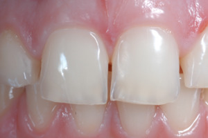 Figure 2 - Early erosive tooth wear on central incisors. This relatively late stage shows loss of surface enamel on the upper incisors and loss of surface form. Early loss of the incisal edge has started and if no preventive action is taken the wear will deteriorate.