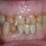  
Figure 3 – If the condition is not prevented, the erosive tooth wear progresses and the loss of incisal edge collapses resulting in visible changes seen by both the patient and dentist.
