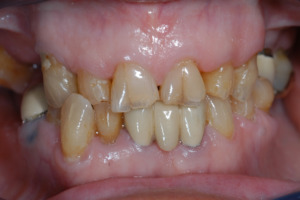 Abbildung 3 –Fortgeschrittener säurebedingter Zahnhartsubstanzverlust, der bereits zu Verkürzung der klinischen Krone geführt hat. 
