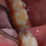 Figure 4 – early enamel wear on the occlusal surface of the 1st molar with small (1mm diameter) cupped out lesion on the mesio-buccal cusp. 