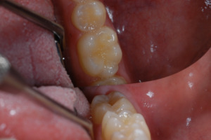 Figure 4 – early enamel wear on the occlusal surface of the 1st molar with small (1mm diameter) cupped out lesion on the mesio-buccal cusp. 