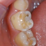 Figure 5 – Early enamel loss on mesio-buccal surface of upper first molar. The mesio buccal cusp can be seen to have an early cupped out lesion. 