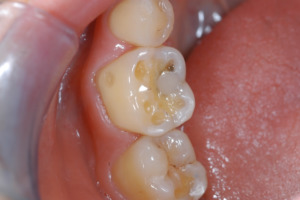 Figure 5 – Early enamel loss on mesio-buccal surface of upper first molar. The mesio buccal cusp can be seen to have an early cupped out lesion. 