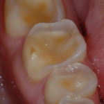Figure 6 – If the central areas merge, the destruction of the tooth deteriorates, resulting in loss of crown height.