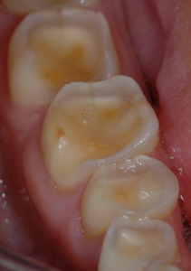 Figure 6 – If the central areas merge, the destruction of the tooth deteriorates, resulting in loss of crown height.